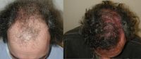 Hair Transplant Scalp Hair Transplant Treatments